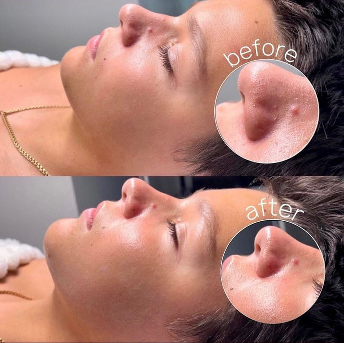 facial skin girls before and after services deep extraction